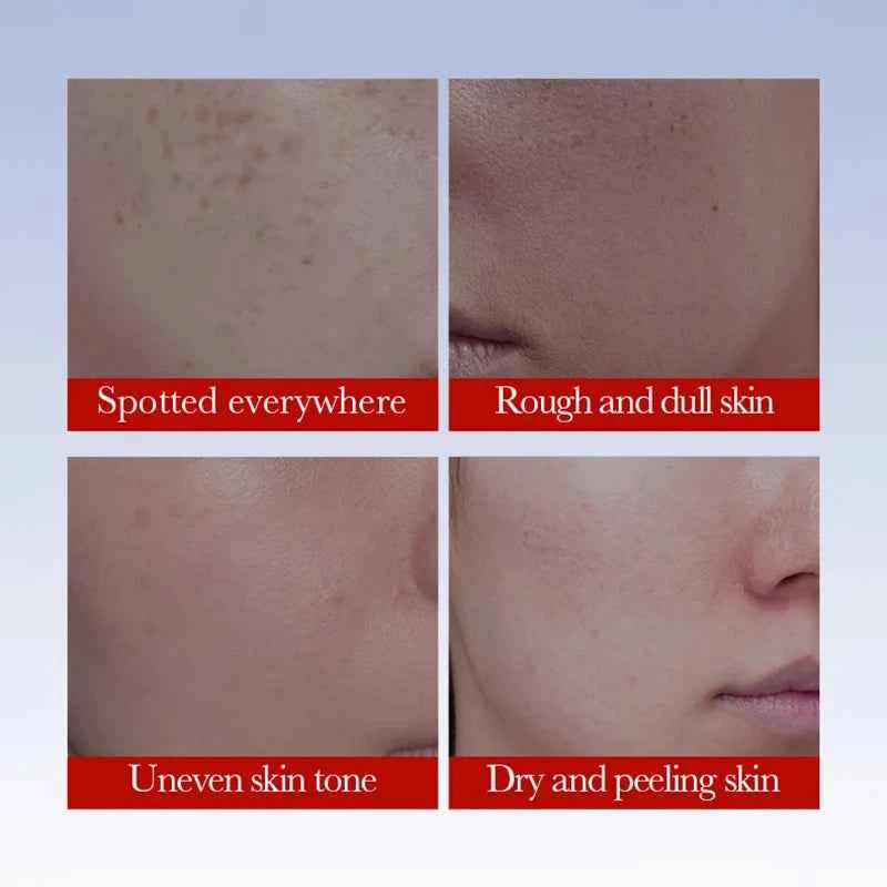 SADOER Anti Freckle Cream Face Whitening Creams Spot Removing Anti-aging Moisturizing Freckles Removal Facial Cream Skin C...